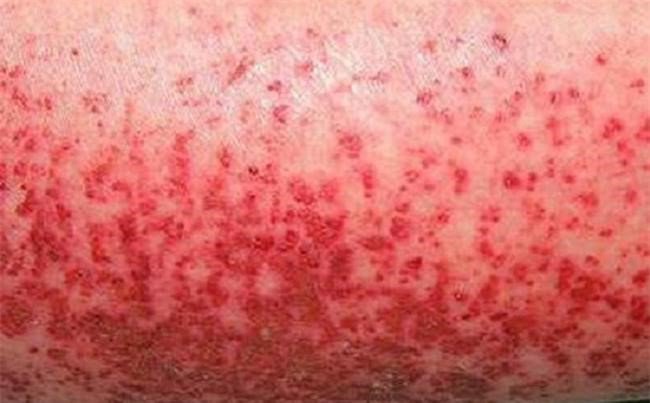 sot xuat huyet o nguoi lon trieu chung va cach dieu tri