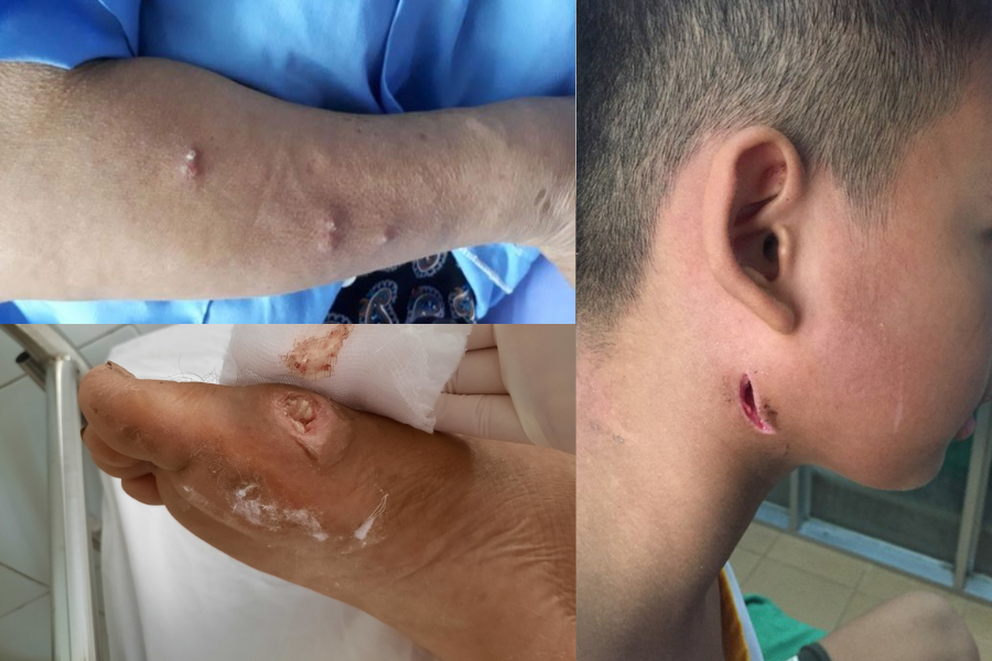 Một vài hình ảnh cho thấy mức độ nguy hiểm của bệnh Whitmore. Một vài hình ảnh cho thấy mức độ nguy hiểm của bệnh Whitmore.