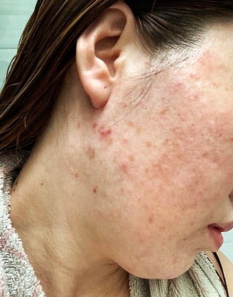 Mộttrongcácbiểuhiệncủa da khinhiễm corticoid