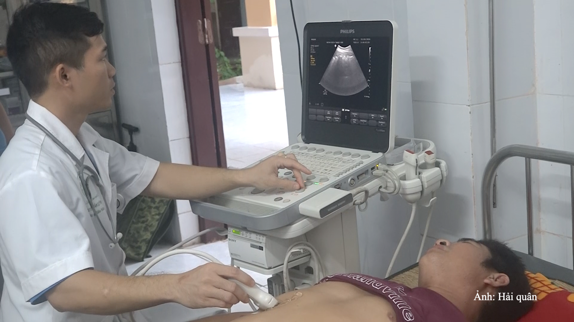 Kết quả siêu âm ngư dân cho thấy, đài bể thận phải giãn.